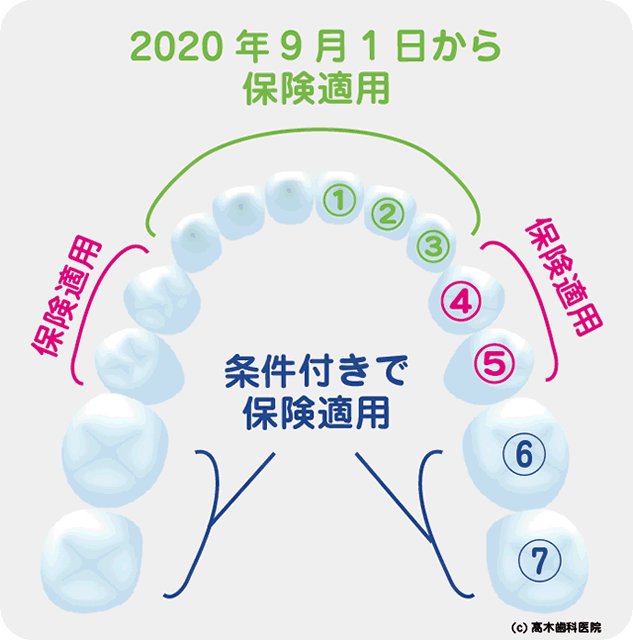 CAD/CAM冠（ハイブリッドセラミック冠/保険適用の白い歯） - 杉戸サン歯科医院